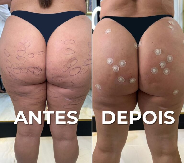 ANTES DEPOIS (1)
