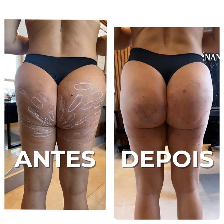 ANTES